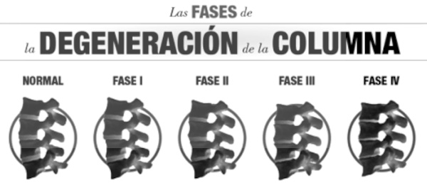 fases subluxacion vertebral
